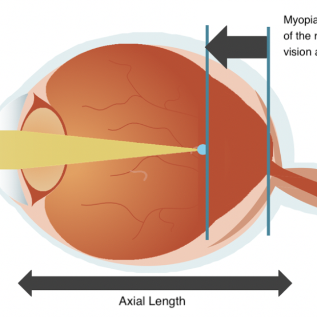 Вища відносна периферична рефракція пов’язана з прискореним розвитком міопії в дітей — дані МРТ-дослідження
